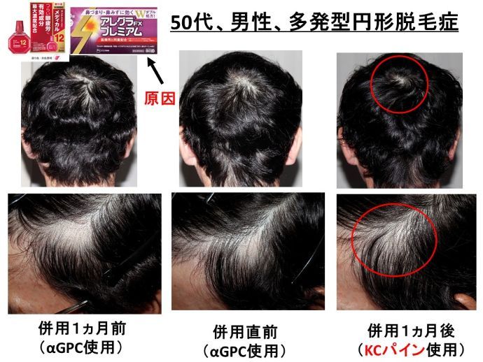 円形脱毛症　病院